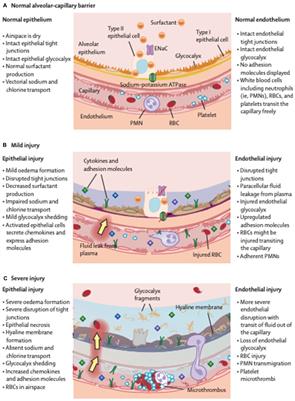 Endothelial dysfunction triggers acute respiratory distress syndrome in patients with sepsis: a narrative review